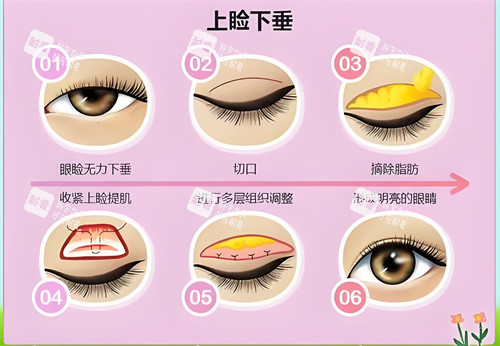 上睑下垂手术图示 上睑下垂手术图示