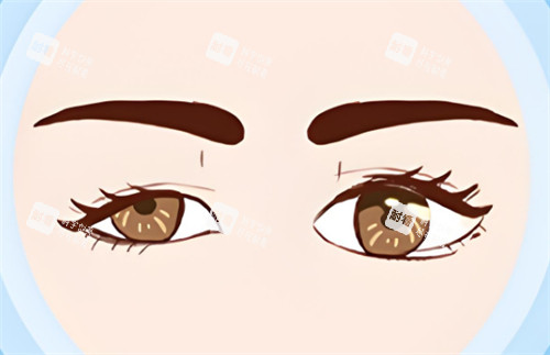 上睑下垂一大一小眼 上睑下垂一大一小眼