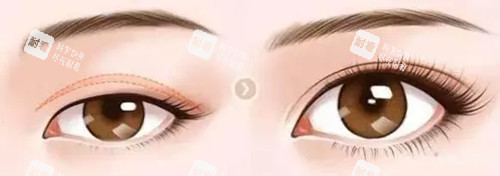 上睑下垂整形前后对比 上睑下垂整形前后对比