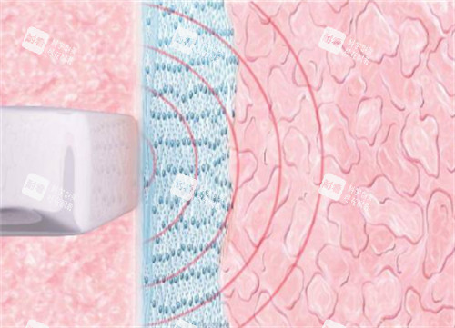 viveve薇蜜私密紧致仪器施术过程图解 viveve薇蜜私密紧致仪器施术过程图解