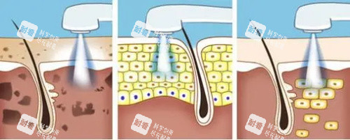 光子嫩肤的过程