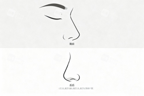 鼻子做整形前后对比图