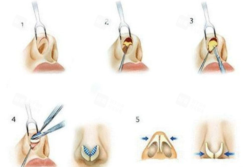 隆鼻手术填充过程展示图 隆鼻手术填充过程展示图