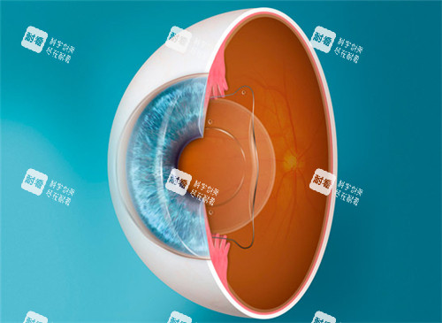 ICL晶体植入图 ICL晶体植入图