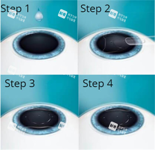 晶体植入手术过程演示图 晶体植入手术过程演示图