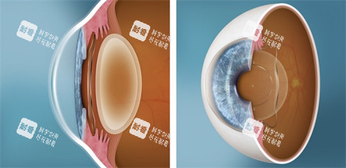 人工晶体植入眼睛对比 人工晶体植入眼睛对比