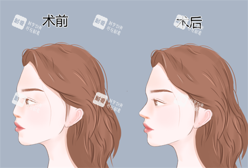 鼻整形手术对比