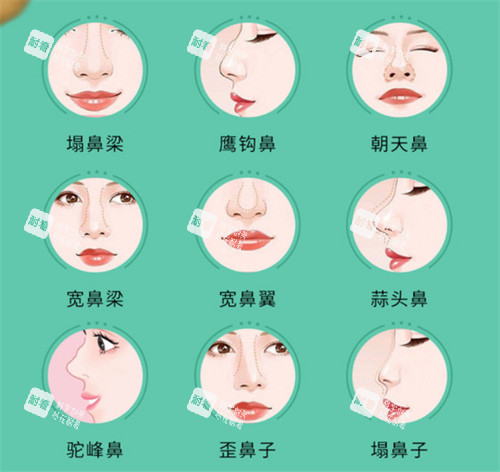 鼻部整形手术适应症