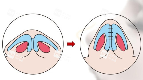鼻小柱抬高手术示意图