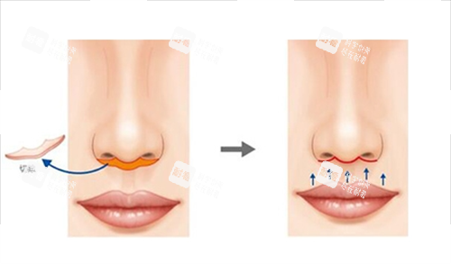 人中缩短手术切除部位