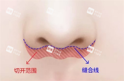埋线人中缩短术手术位置图解 埋线人中缩短术手术位置图解