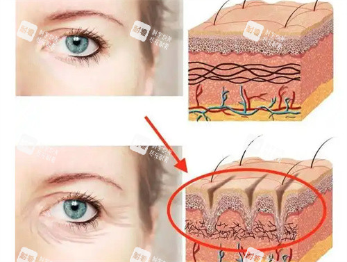 眼周筋膜提升前后 眼周筋膜提升前后