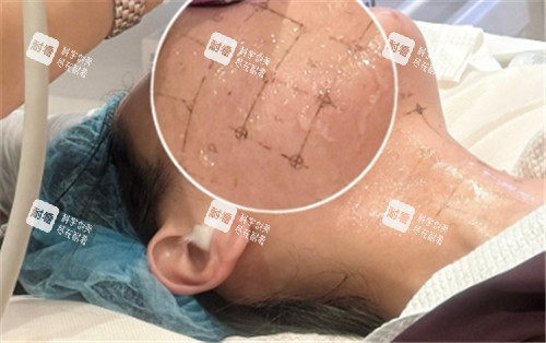 热玛吉点位设计