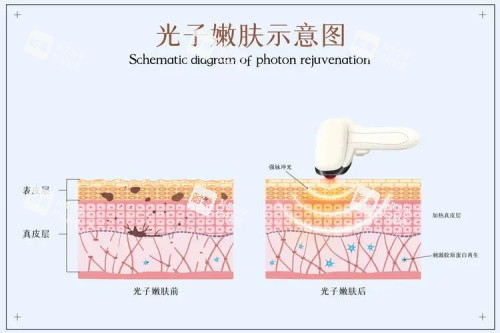 光子嫩肤的示意图