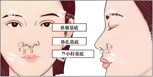 朝天鼻手术点位展示动画图