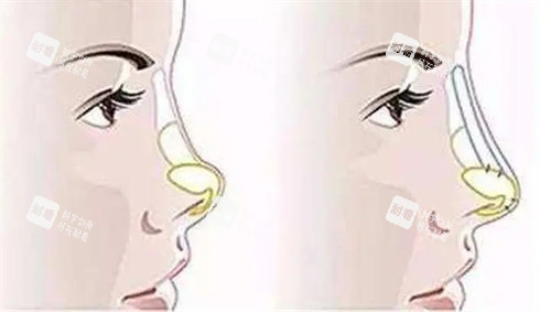 朝天鼻填充假体