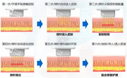 微针操作流程图解