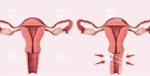 3D生物束带紧缩术对比图