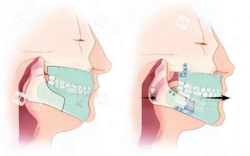 颏成形术动画演示图 颏成形术动画演示图