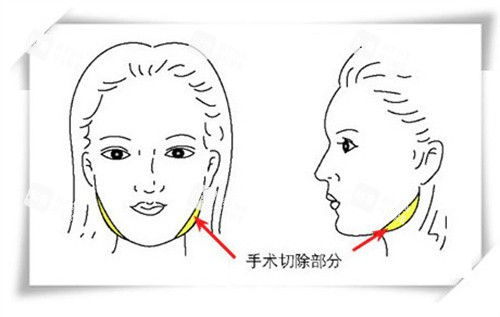 下颌角截骨手术 下颌角截骨手术
