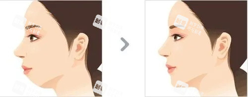 下巴整形对比图