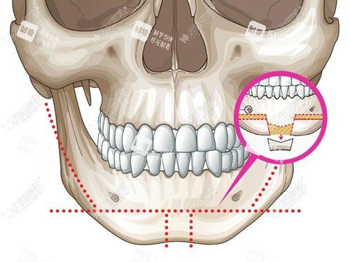 T型截骨术手术切口演示动画图 T型截骨术手术切口演示动画图