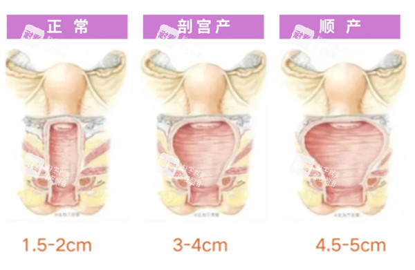 正常阴道和松弛对比照片