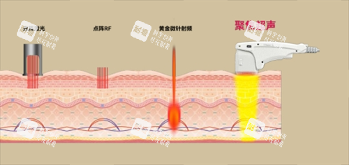 尖峰超声王作用皮肤层次透视图 尖峰超声王作用皮肤层次透视图