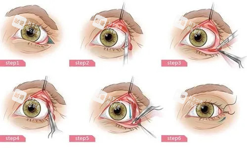 内切法眼整形卡通示意图 内切法眼整形卡通示意图
