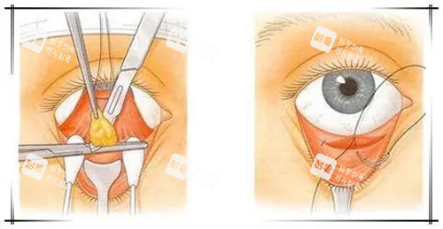 内切法祛眼袋卡通示意图 内切法祛眼袋卡通示意图
