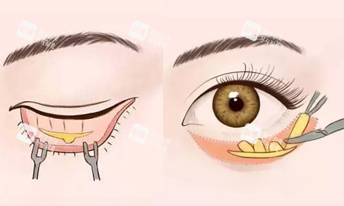 内外祛眼袋切口对比展示