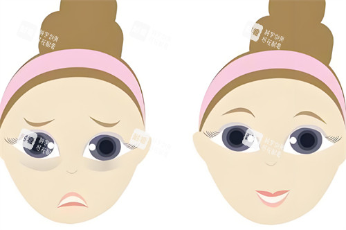 中年祛眼袋前后对比 中年祛眼袋前后对比