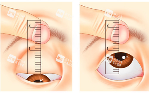 眼睑是否下垂自测图