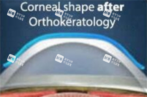 戴角膜塑形镜后角膜形状 戴角膜塑形镜后角膜形状