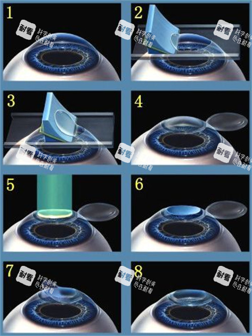 近视手术的手术过程 近视手术的手术过程