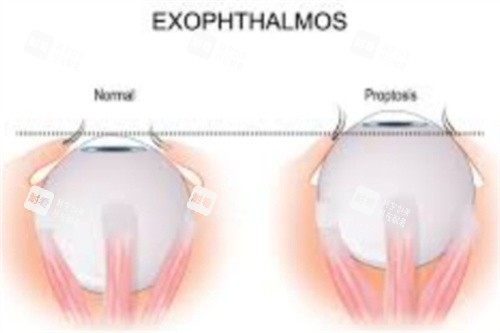 近视造成突眼 近视造成突眼