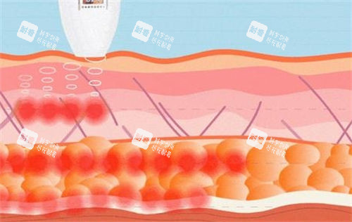 超声炮仪器作用在皮肤侧剖图