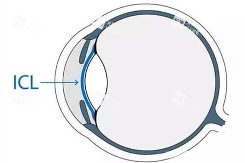 王乐今眼球震颤手术结果怎么样?手术数据、适用人群、患者反馈都在这！