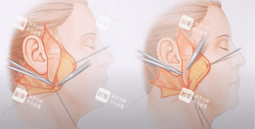 北京加减美v9手术原理深层错位固定