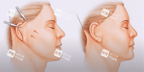 北京加减美v9手术优势提拉量大作用明显