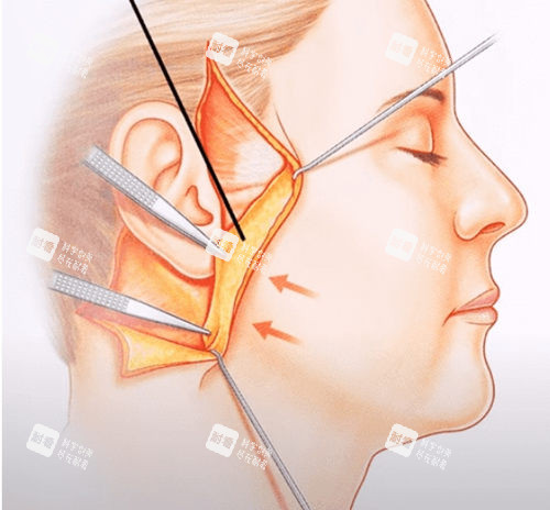 北京加减美v9手术原理提拉方向