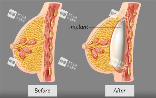 假体隆胸植入的层次