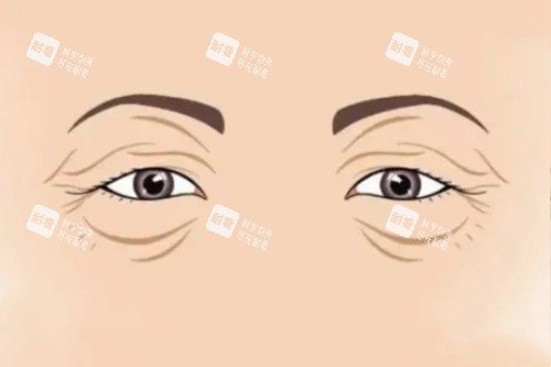眼部衰老卡通图 眼部衰老卡通图