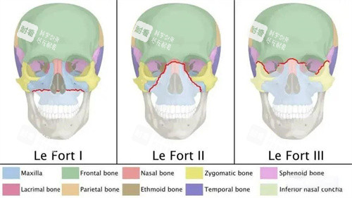 Le Fort三种手术方式演示图