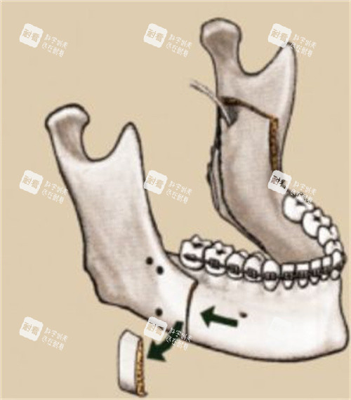 下颌垂直截骨术演示动画图