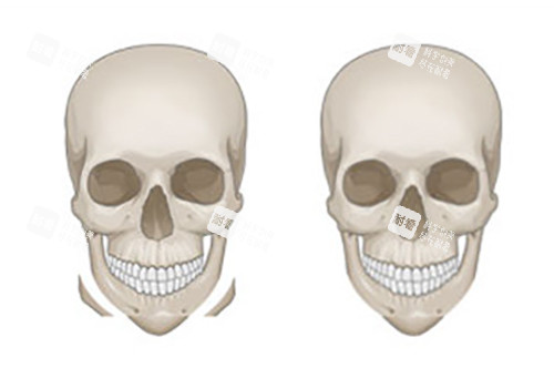 下颌削骨示意图