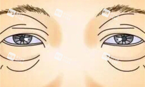 眼袋展示卡通图