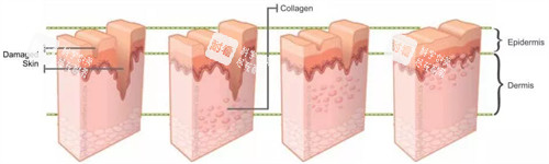 凹陷疤痕填充前后对比