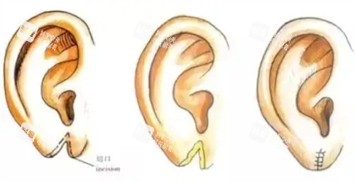 耳垂裂开修复的过程