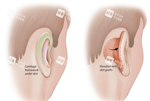 畸形的耳朵对比图